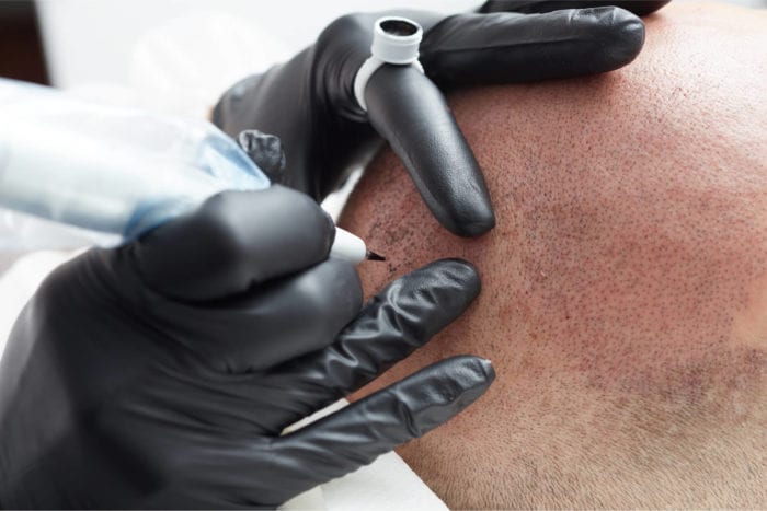Medical Tattooing – Skin camouflage
