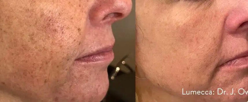Lumecca Treatment