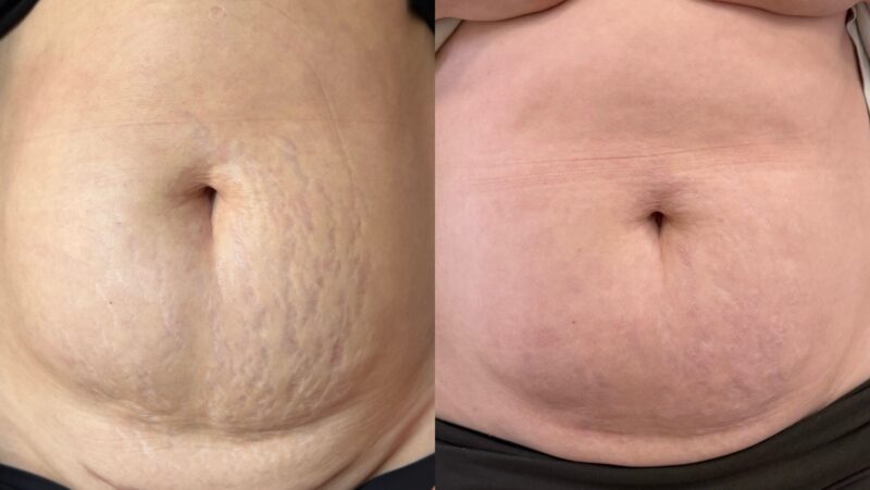 Before and after Morpheus8 Body treatment showing improved skin tightening, smoother texture and reduced loose skin on the abdomen at Jenny Cader Skin & Aesthetics in Hertford.