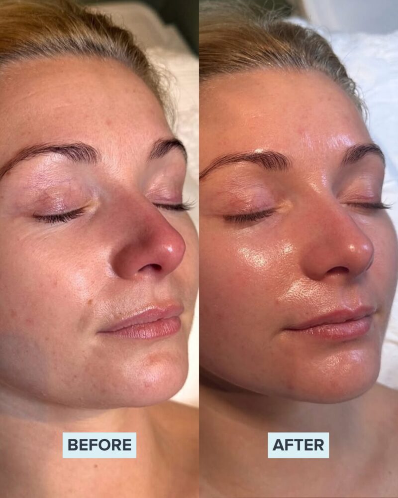 Before and after results of a professional chemical peel treatment at Jenny Cader Clinic.