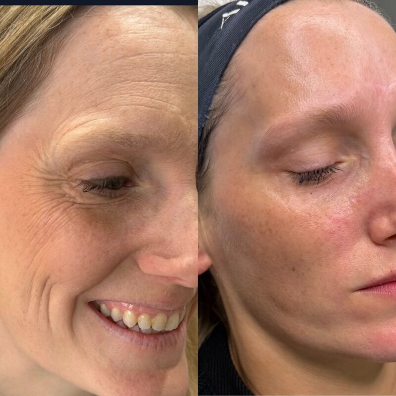 Before and after anti-wrinkle injections showing reduced crow's feet and smoother skin around the eyes during expression.