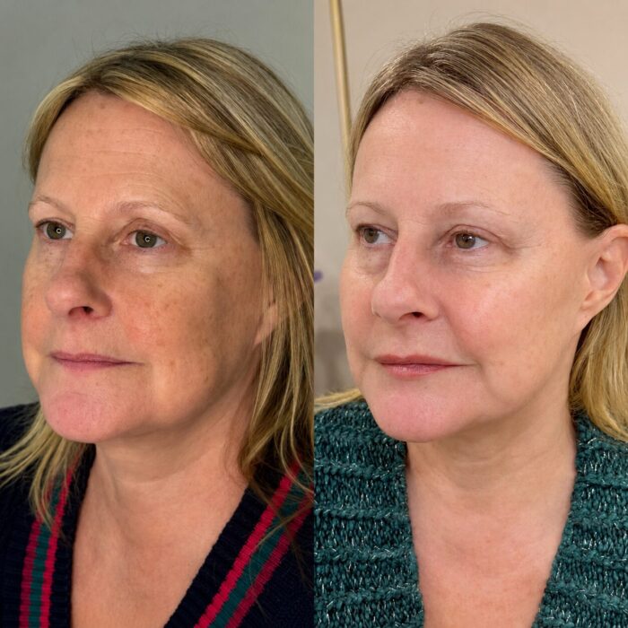 Before and after facial rejuvenation treatment showing smoother facial contours, improved skin appearance and natural-looking rejuvenation.