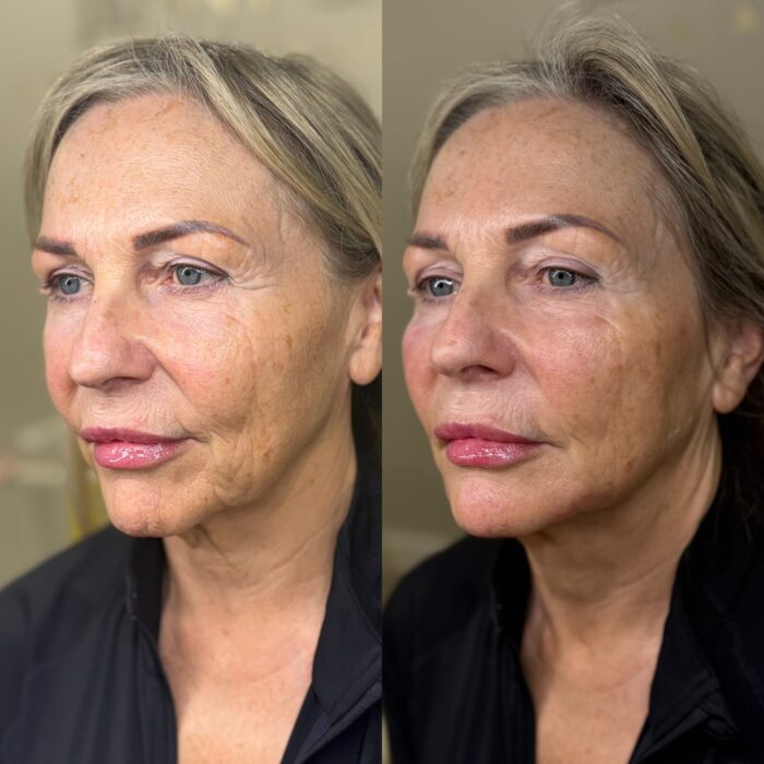 Before and after facial contouring treatment demonstrating enhanced facial definition, restored volume and balanced facial proportions.