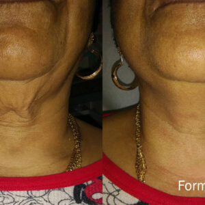 Before and after Forma® skin tightening treatment improving loose neck skin, skin laxity and definition beneath the chin.