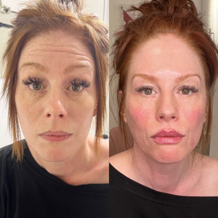 Before and after full face rejuvenation demonstrating improved facial contours, restored volume and a naturally refreshed appearance at Jenny Cader Clinic.