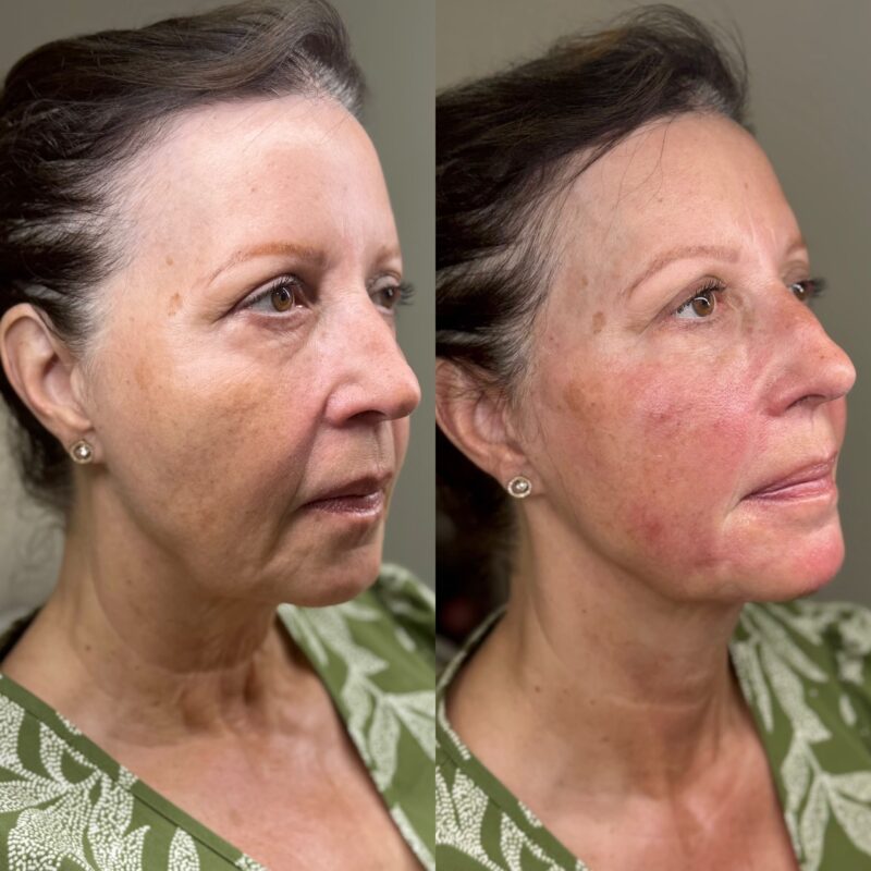 Before and after facial rejuvenation showing restored facial structure, improved definition and natural-looking volume restoration.