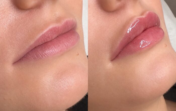 Before and after lip filler treatment showing enhanced lip volume, improved definition and natural-looking lip proportions at Jenny Cader Clinic.