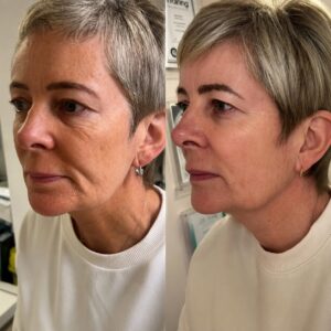 Before and after Morpheus8 treatment showing improved skin firmness, smoother texture and enhanced facial definition through radiofrequency microneedling.
