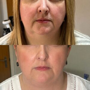 Before and after Morpheus8 treatment showing improved skin firmness, jawline definition and reduced lower face laxity with natural-looking rejuvenation.
