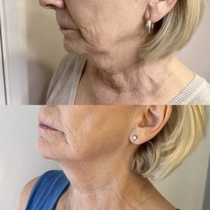 Before and after Morpheus8 treatment showing improved skin tightening and jawline definition at Jenny Cader Skin & Aesthetics in Hertford.