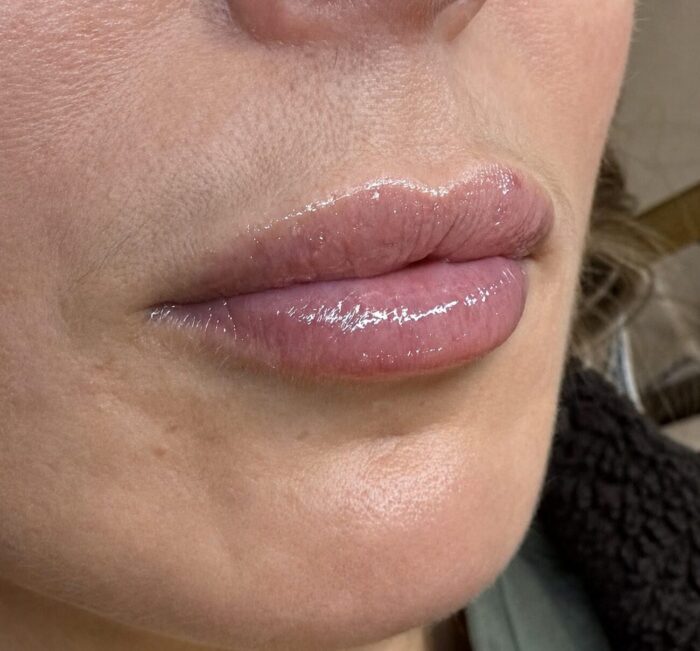Close-up of naturally enhanced lips following dermal filler treatment, showing improved shape, hydration and definition.