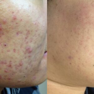 Before and after SkinPen® Precision microneedling treatment showing improvement in acne scarring, skin texture and overall skin clarity.