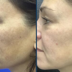 Before and after SkinPen® Precision microneedling treatment showing improved skin texture, reduced discolouration and a more even skin tone.