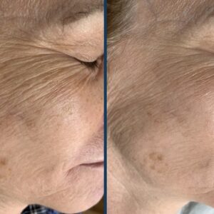 Before and after SkinPen® Precision microneedling treatment demonstrating improved collagen support, smoother crow's feet and healthier-looking skin.
