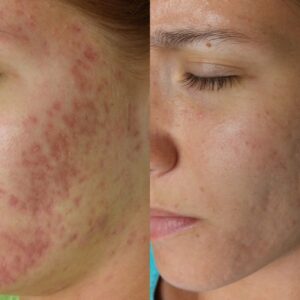 Before and after SkinPen® Precision microneedling treatment showing improvement in acne scarring, post-inflammatory redness and skin texture.