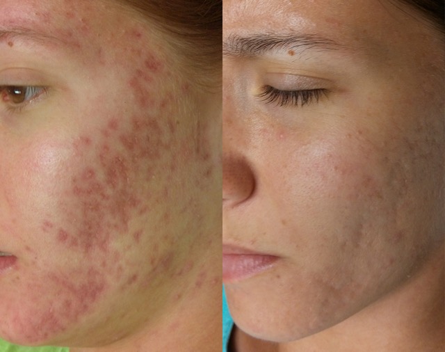 Before and after SkinPen® Precision microneedling treatment showing improvement in acne scarring, post-inflammatory redness and skin texture.