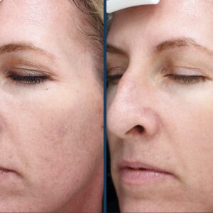 Before and after SkinPen® Precision microneedling treatment showing smoother skin texture, refined pores and improved overall skin quality.