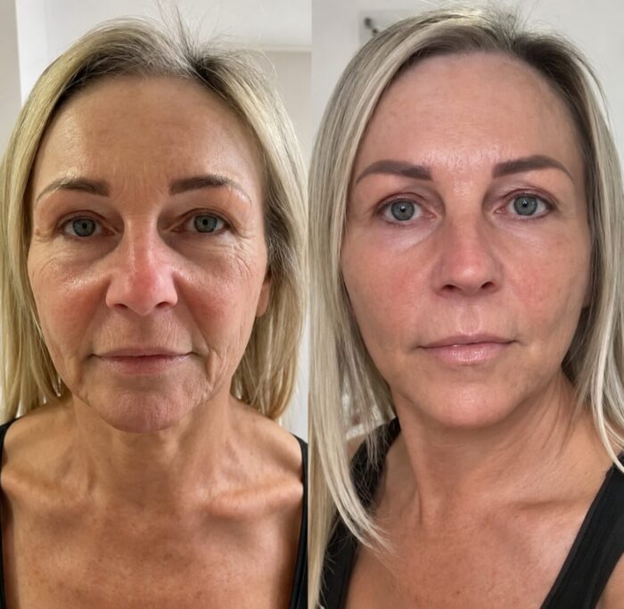 Before and after full face rejuvenation showing smoother skin, improved facial contours, restored volume and a brighter, more youthful appearance.